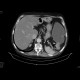 Carcinoma of colon, lienal flexure, large bowel ileus, lung metastasis: CT - Computed tomography